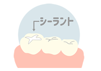 シーラント